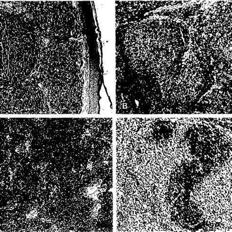 A Strong Cd Immunostaining Highlights The Follicular Pattem Cd