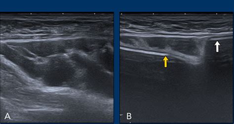 The Radiology Assistant Breast Implants