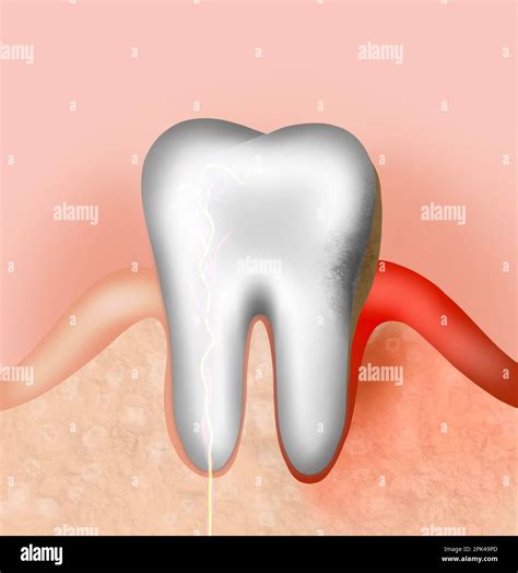 Infected Gum And Tooth Illustration Periodontal Disease Stock Photo