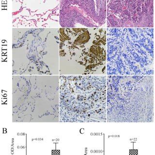 Immunohistochemistry Analysis Of Krt In Ac Patients In A Five Years