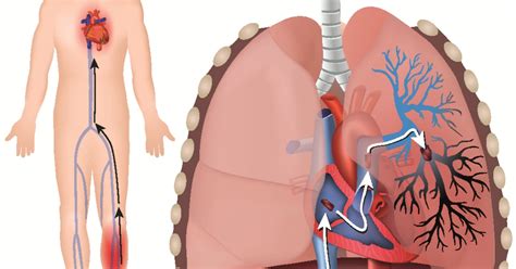 Pulmonary Embolism Symptoms Risks Complications Diagnosis Treatment Prevention