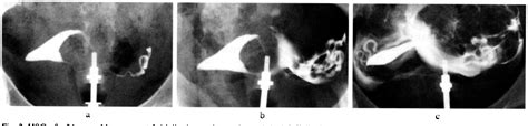 Figure 2 From Frequency Of Proximal Tubal Obstruction In Patients