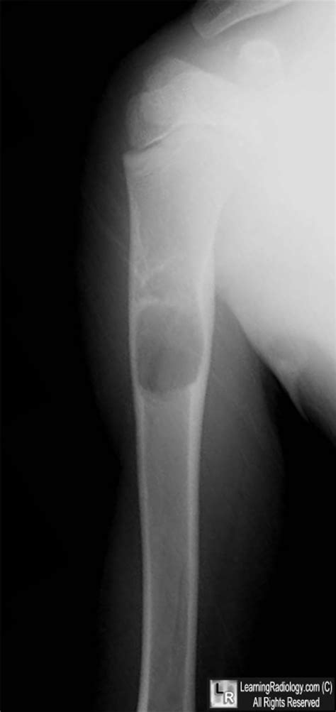 Learningradiology Unicameral Bone Cyst Solitary Simple Fallen Fragment