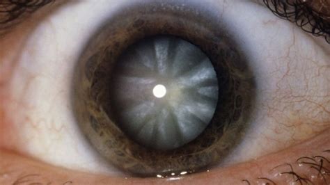 ‘stunning Operation Regenerates Eyes Lens Stem Cells Eyes Cataract