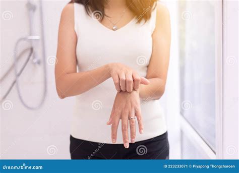 Woman With Rash Or Papule And Scratch On Her Hands From Allergies