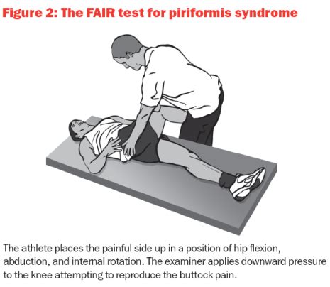 Piriformis Syndrome The Causes Diagnosis And Treatment Of This Common