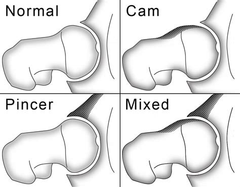 Femoroacetabular Impingement Fai Baton Rouge La Hip Arthroscopy