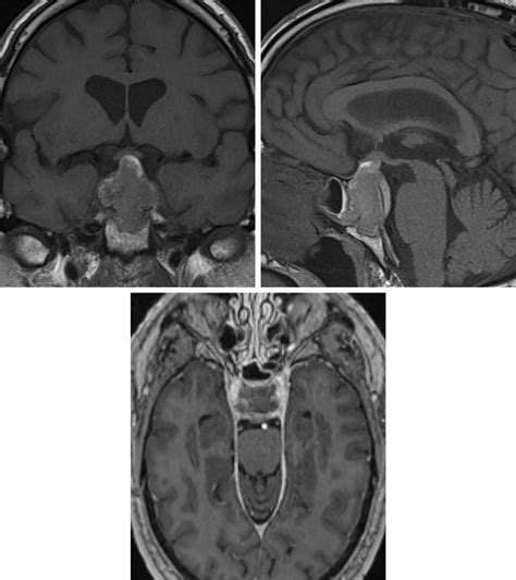 Craniopharyngioma Mri T