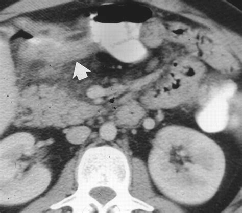 Mesenteric Adenitis Ct Diagnosis Of Primary Versus Secondary Causes Incidence And Clinical