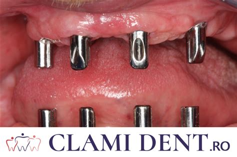 Implant Dentar Alba Iulia Ghid Complet Pentru Pacien I