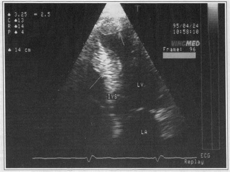 Figure From Asymmetric Hypertrophic Cardiomyopathy Diagnosed By