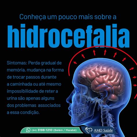 Hidrocefalia Causas Sintomas E Tratamentos Resumo Escolar Otosection