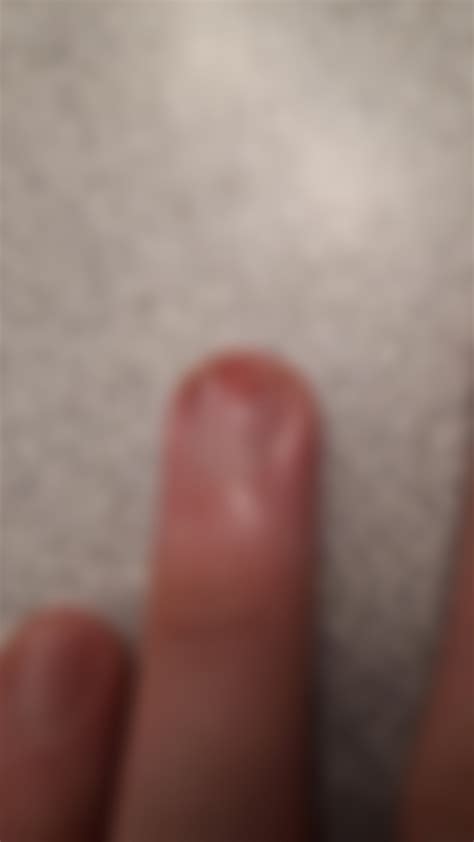 Sanded part of fingernail off : r/InjuriesAndWounds