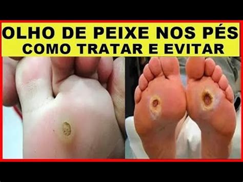 Remédio Caseiro Para Olho de Peixe Natural Rápido e Fácil YouTube