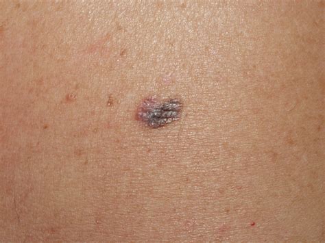 Immagini Melanoma E Tumori Della Pelle In Diversi Stadi Milano