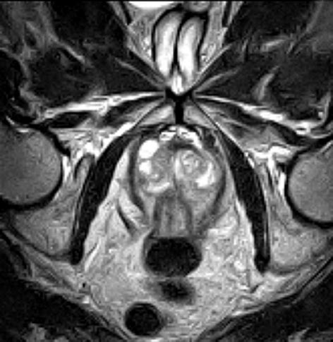 Prostate Mri Scan Medserena Open Mri