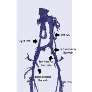 Three Dimensional Computed Tomography Angiography Of The Inferior Vena