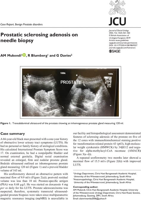 Prostatic Sclerosing Adenosis On Needle Biopsy Am Mukendi R Blumberg