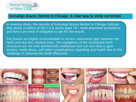 Ppt Invisalign Braces Dentist In Chicago A Clear Way To Smile