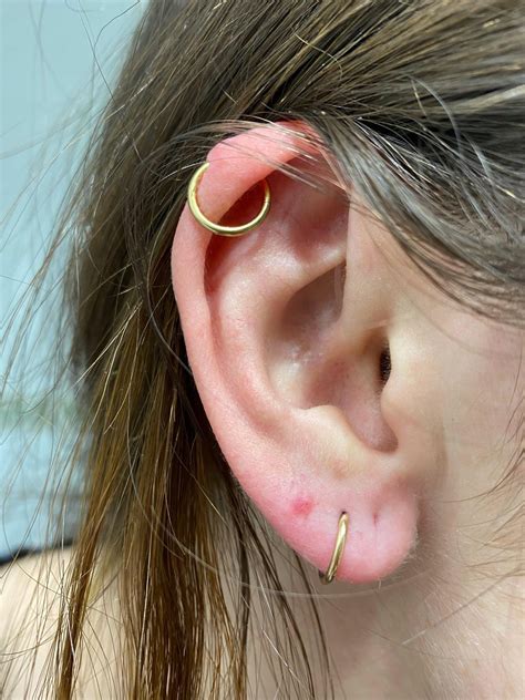 [irritation Bump Keloid] I Got A Helix And An Upper Lobe Piercing In 2020 Helix Developed A