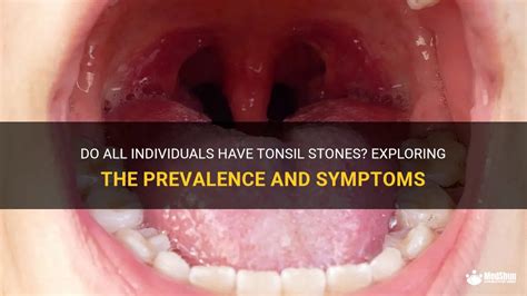 Do All Individuals Have Tonsil Stones Exploring The Prevalence And