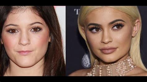 Kylie Jenner Before And After Surgery Youtube