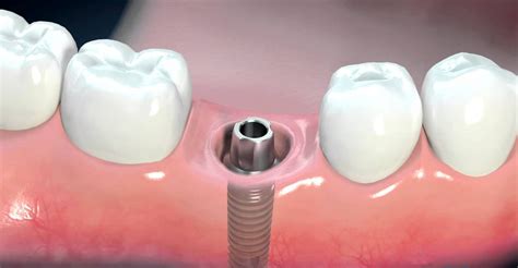 Cấy ghép implant là gì NHA KHOA MINH KHAI