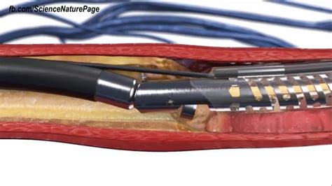 Cirurgia Endovascular T Cnica N O Invasiva Para Tratamentos De