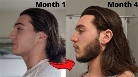 4 Month Minoxidil Beard Transformation Beard Growth Results Youtube