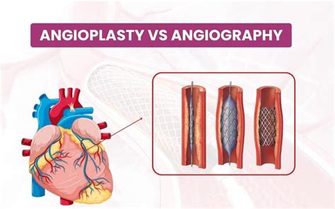 Decoding Angioplasty Vs Angiography Critical Differences Revealed