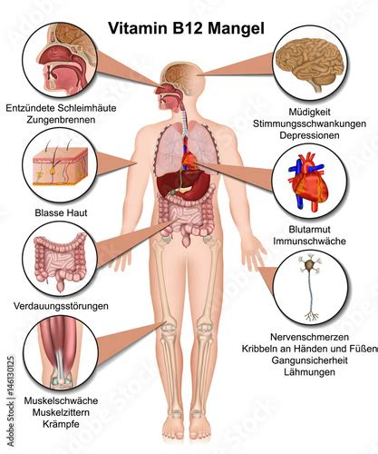 Vitamin B12 Mangel Anzeichen Und Symptome Vektor Illustration