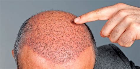 Surgical Hair Loss Recovery In Toronto And Thornhill Dr Larry Fremont