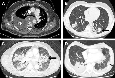 Pulmonary Manifestations Of Lymphoma And Leukemia Clinics In Chest Medicine