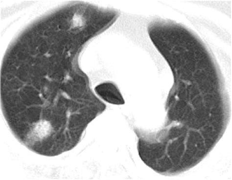 New Focal Ground Glass Opacities Right Upper Lobe Download Scientific Diagram