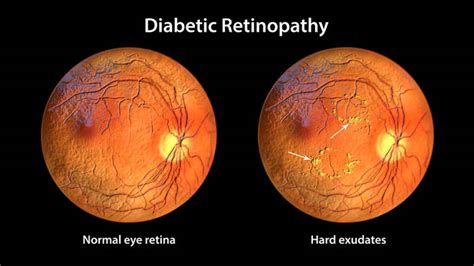非增生性糖尿病视网膜病变图像显示正常眼视图片 包图网企业站
