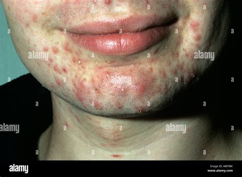 Facial acne showing pustules & inflammation Stock Photo - Alamy