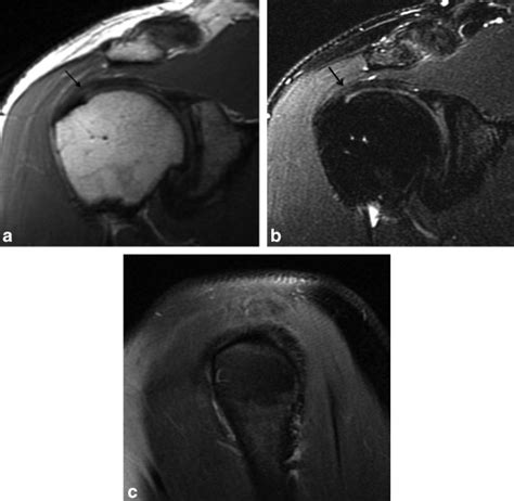 Acromial Undersurface Based On Biglianis Classification Type I Has A