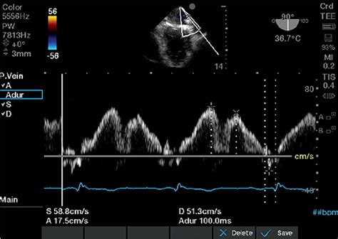 Flujo venoso pulmonar con ecocardiografía transesofágica