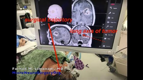 Awake Mini Pterional Craniotomy Gbm Glioblastoma And Minimally