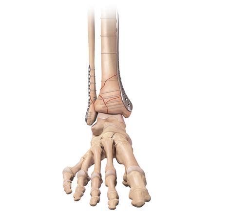 Arthrex Distal Tibia Plating System