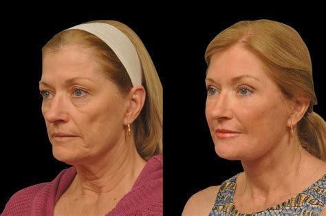 Patient 410812 Changes Rapid Lift Before And After Photos Changes