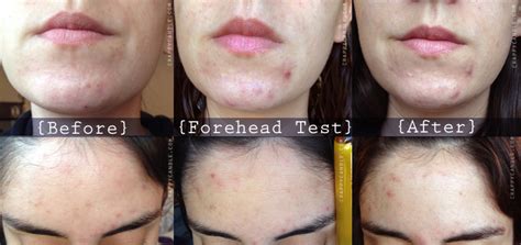 Jojoba Oil Review - The Acne Experiment | Jojoba oil acne, Acne oil, Acne pit scars