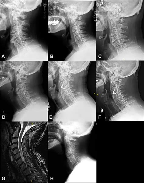 Anterior Cervical Osteophyte Resection For Treatment Of Dysphagia Joshua M Kolz Mohammed A