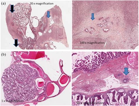 Histological Examples Of Ovarian Metastases Of Pancreatic Download