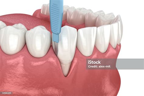 Gingiva Recession Soft Tissue Graft Surgery 3d Illustration Of Dental