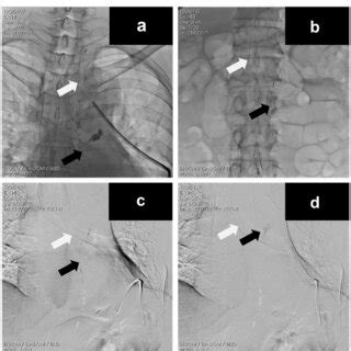 Fluoroscopic X Ray Image During Lymphangiography A Two Thoracic Ducts