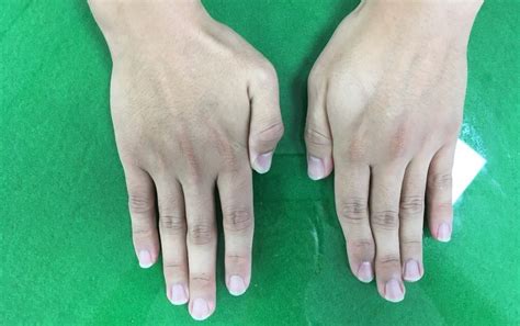 Atrophy of the first dorsal interosseous muscle (affected hand) is ...