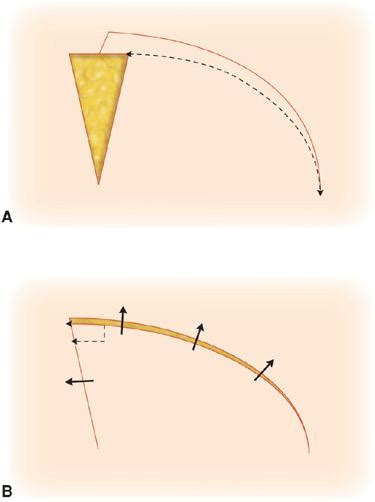 Rotation Flaps Plastic Surgery Key