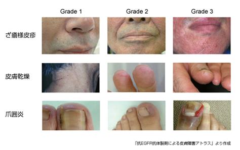 皮膚障害 1 分子標的薬の皮膚障害｜副作用対策講座｜消化器癌治療の広場 Gi Cancer Net