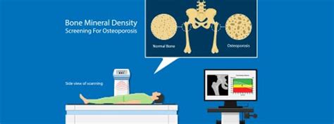 Bone Density Test: Procedure, Risks, Results